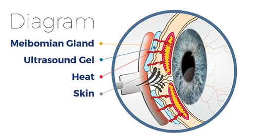 Dry Eye Diagram.png