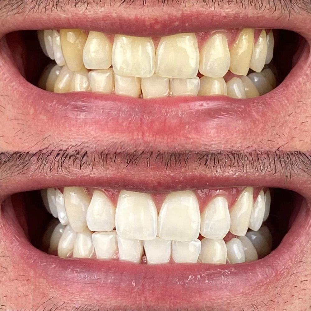 mobile teeth whitening sydney before and after