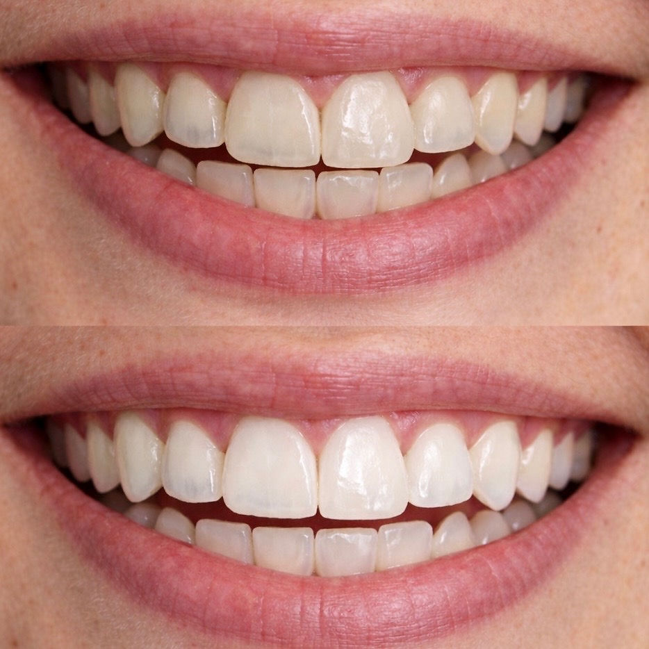 before and after professional teeth whitening sydney