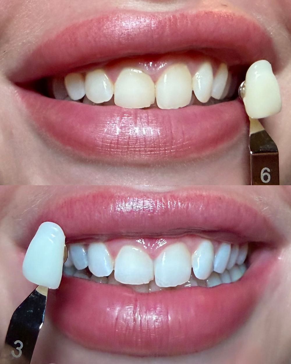 teeth whitening sydney