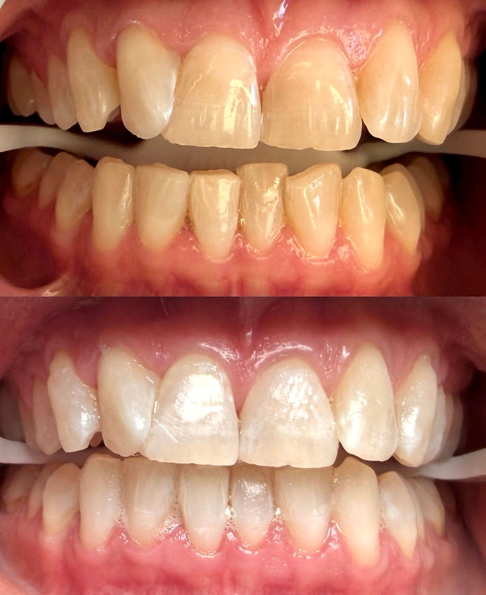 professional teeth whitening sydney mobile