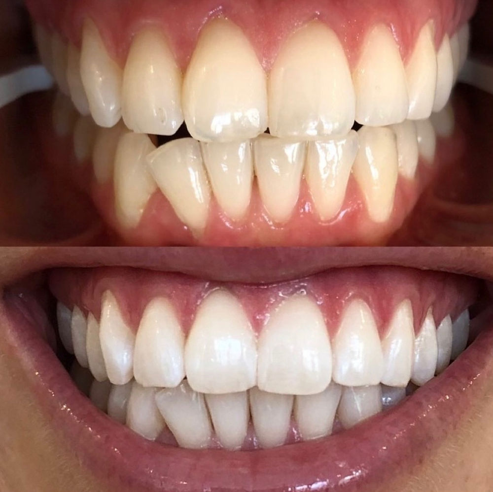 professional teeth whitening results sydney