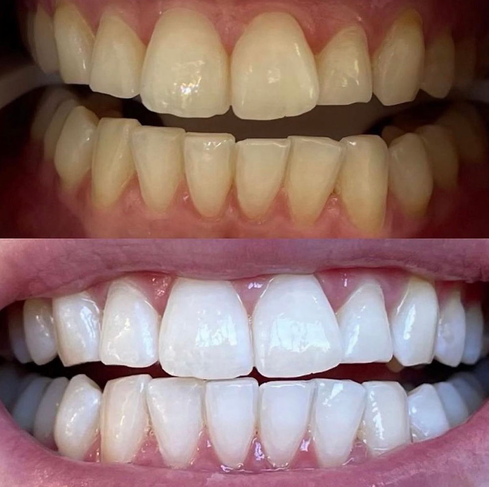 professional teeth whitening sydney mobile