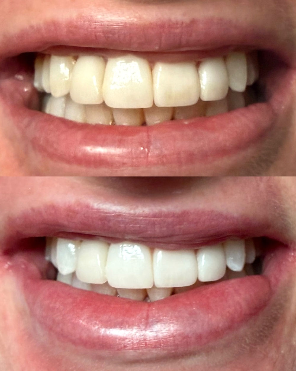 sydney professional teeth whitening