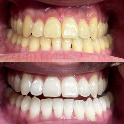 teeth whitening sydney mobile