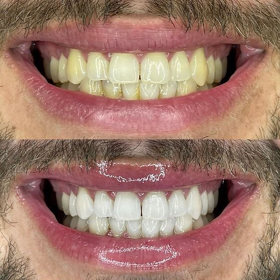 cosmetic teeth whitening sydney before and after results