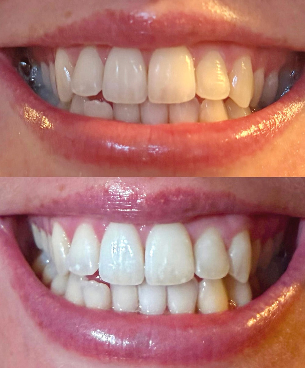 Sydney teeth whitening eastern suburbs