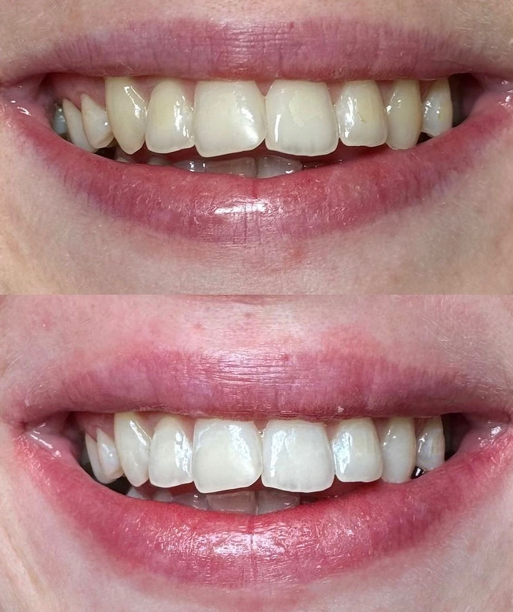 mobile teeth whitening sydney