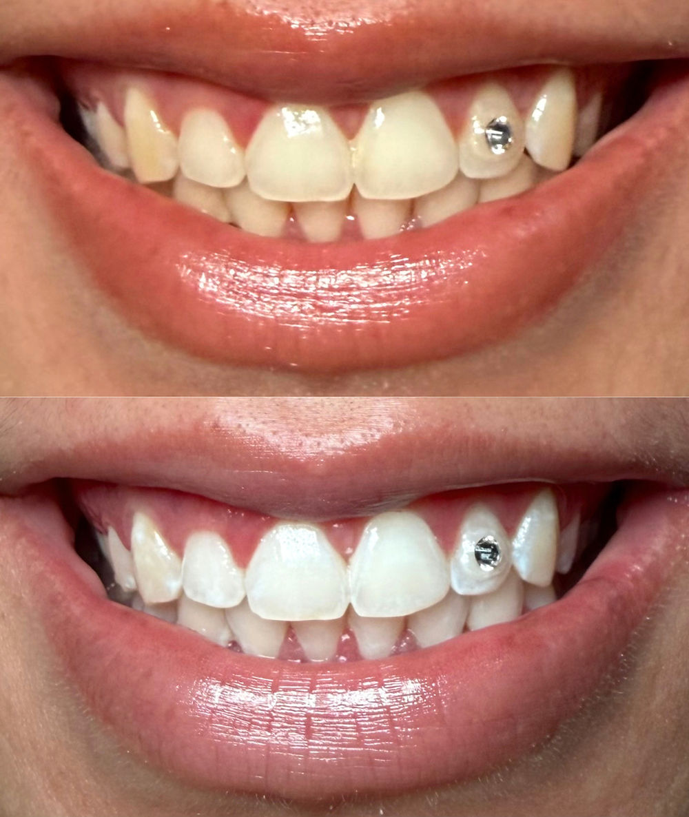 mobile cosmetic teeth whitening sydney results