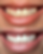 eastern suburbs best mobile teeth whitening