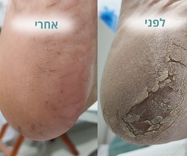 סדקים בעקב