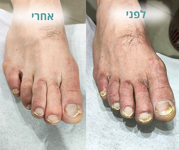 פדיקור רפואי לגברים