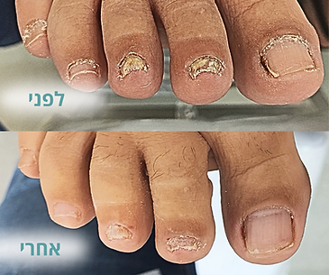בעיות ציפורניים