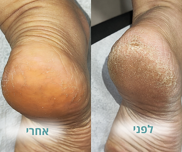 סדקים בעקב