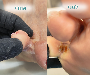 יבלת