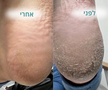 עור יבש וסדוק