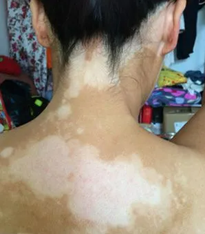 中医对白癜风的辩证与治法