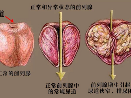 中医对前列腺增生的辩证与治法