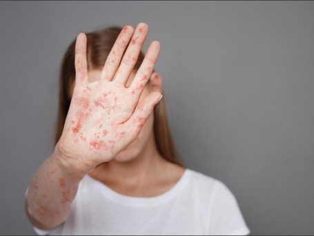 ALERTA!   AUNMENTAN CASOS DE SARAMPION EN GUATEMALA