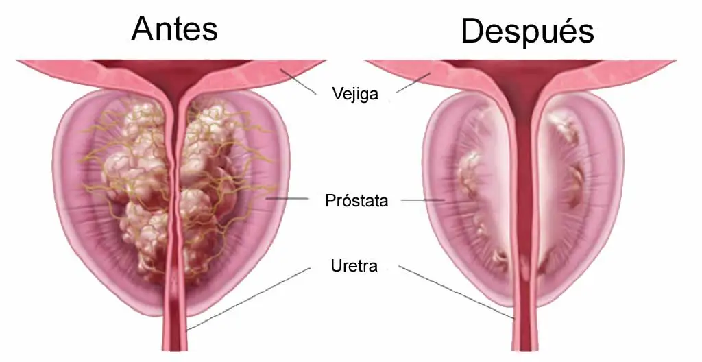 rezum-urologia-avanzada-puebla