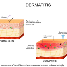 Seborrheic Dermatitis, What do we know, and What is new