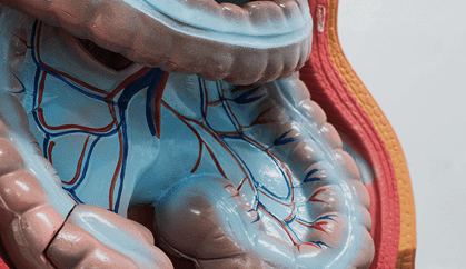 Diverticular Disease: Diverticulosis & Diverticulitis