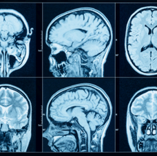 Understanding Neuroimaging: Definition, Applications, and Modalities 