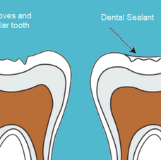 Dental Sealants and Childhood Cavity Prevention