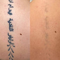 body-tatto-removal-whitby-ontario.jpg