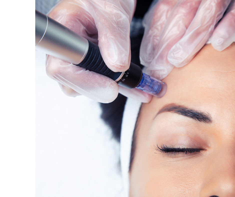 PDRN Microneedling in Dublin