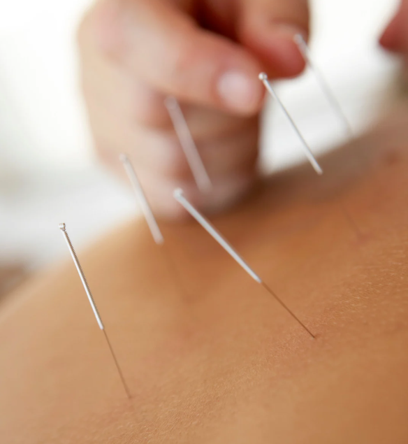 Acupuncture