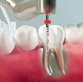 studio-dentistico-verona-Endodonzia-1024