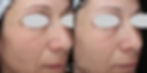 Before and After PhotoTractional Treatment Face