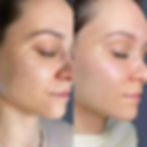 Before and After Laser Treatment Cheek