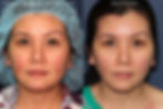 Before and After Laser Chicken Pox Scar Removal Face