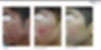 Before and After Acne Treatment Cheek