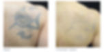 Before and After Back Tattoo Removal