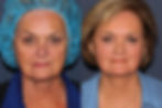 Before and After PhotoTractional Treatment Face