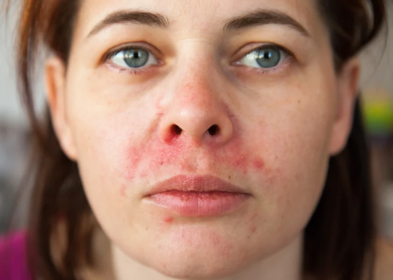 Eczema Peel Treatment