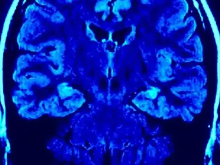 Scientists Discover Ketamine Elevates Brain Activity