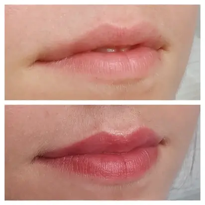 Lip Blush results with DermaClinic Bristol