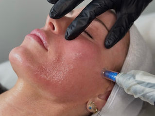 Microneedling i Oslo - slik fornyer du huden med Microneedling