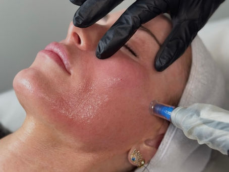 Microneedling i Oslo - slik fornyer du huden med Microneedling