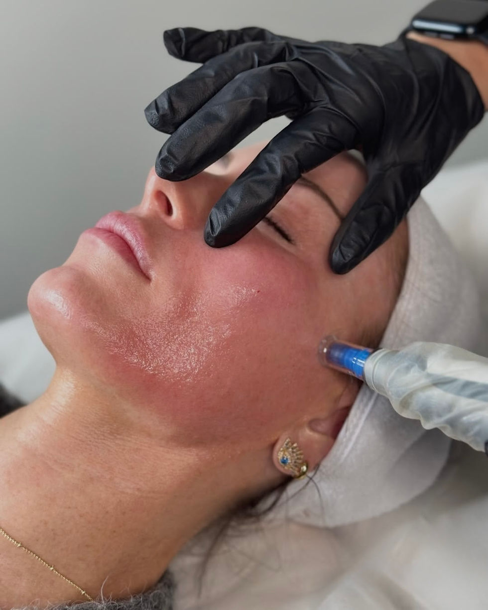 Microneedling i Oslo - slik fornyer du huden med Microneedling