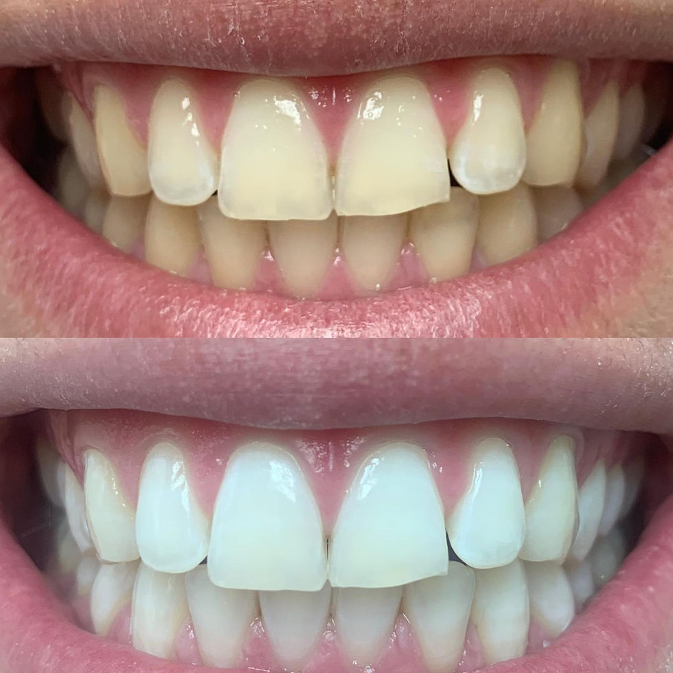 Close-up di denti bianchi e luminosi dopo sbiancamento professionale