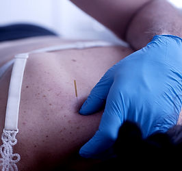 Dry-Needling