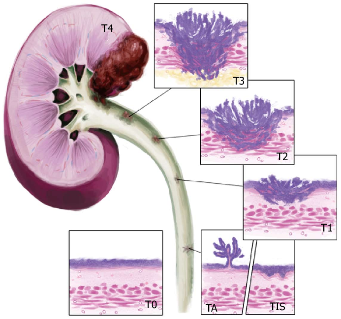 Stages of UTUC