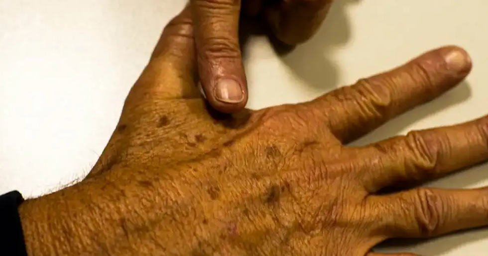 Salvador recebe workshop gratuito para profissionais da beleza sobre prevenção ao melanoma