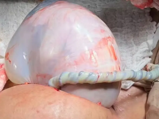 Bebê nasce envolto em bolsa em caso de parto raro em Irecê