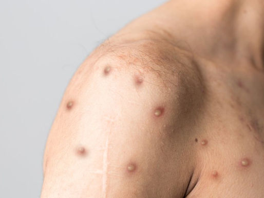 Varíola dos macacos não é mais uma emergência sanitária global de saúde, diz OMS